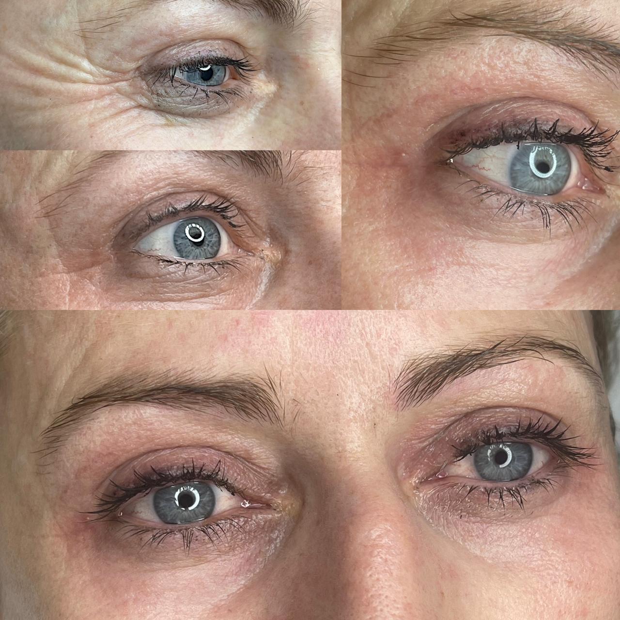 Plasma Βλεφαρόπτωση before/after