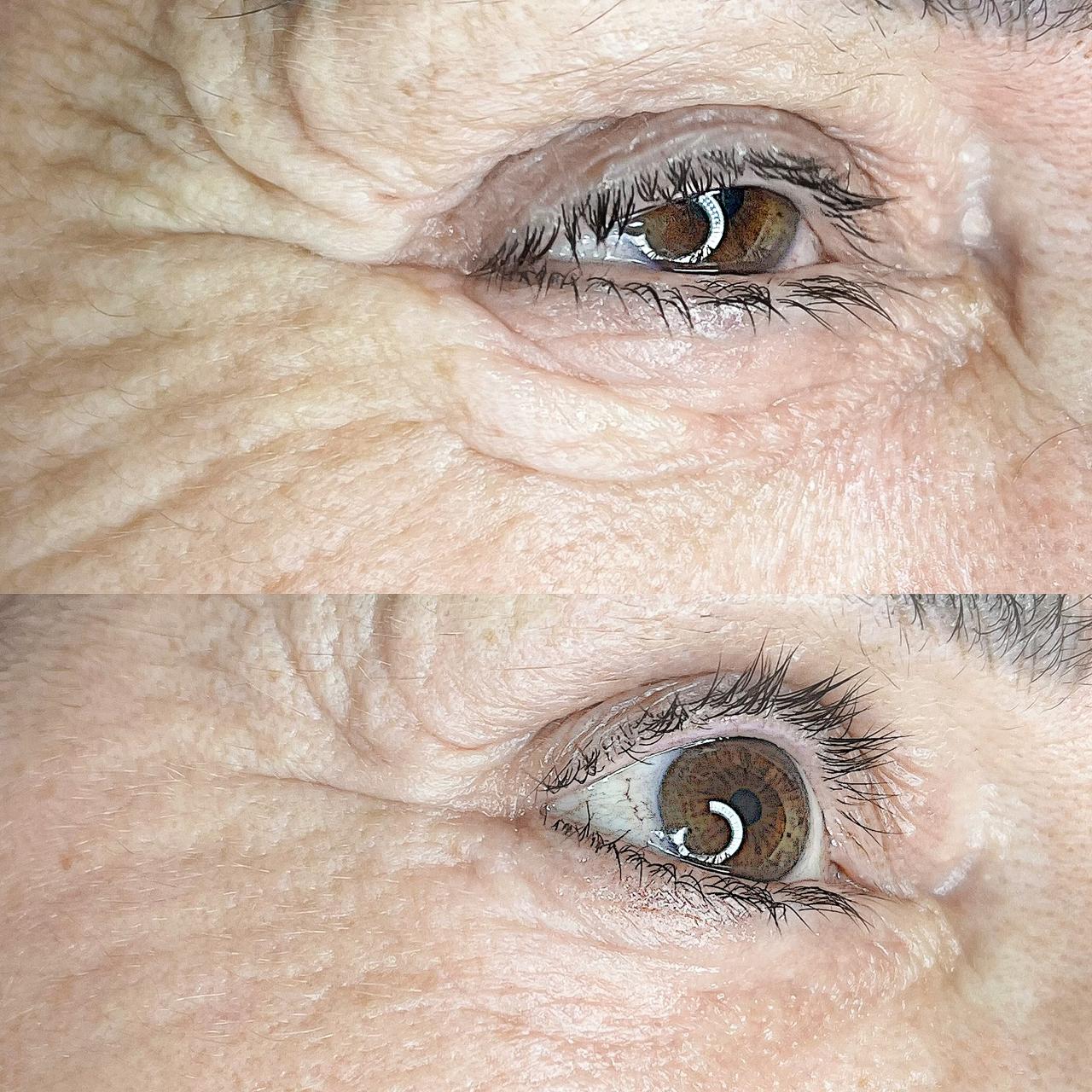 Plasma ανόρθωση ματιού before/after