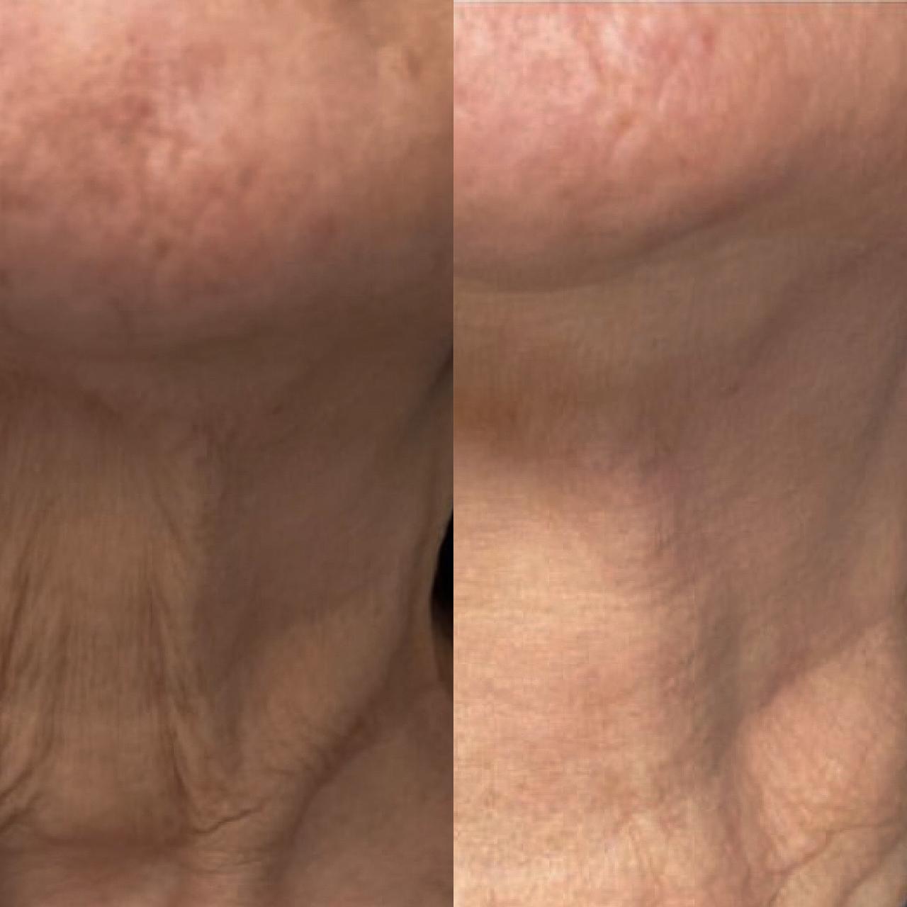 Plasma αφαίρεση ρυτίδων before/after