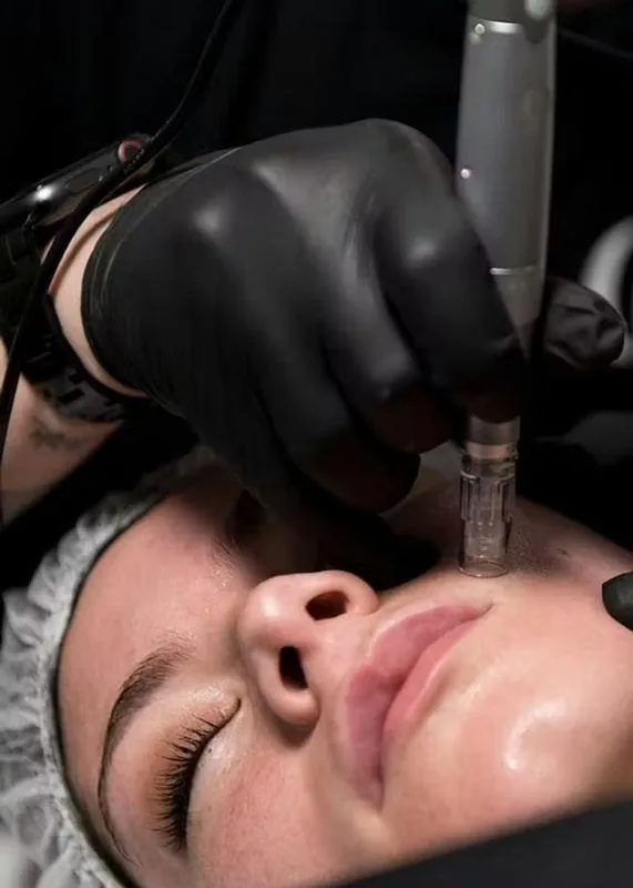 PhiBright Microneedling