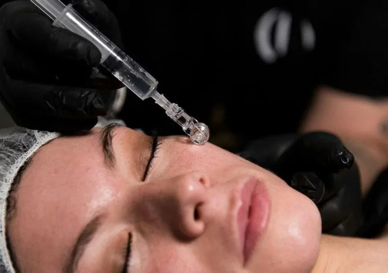 PhiBright Microneedling