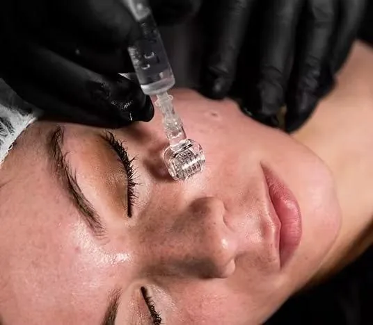 Microneedling session